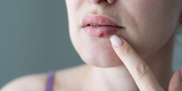 STUDIU. Cum a apărut virusul care provoacă herpesul facial. Ar putea avea o vechime „surprinzătoare” de doar 5.000 de ani