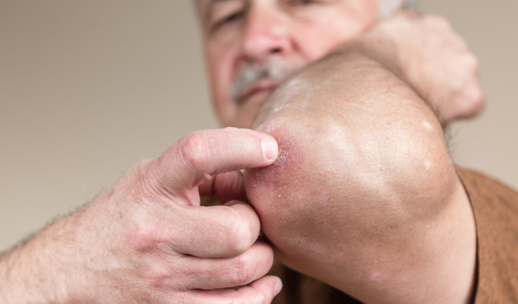 Un bărbat din Alba, care suferă de psoriazis vulgar, a câștigat în instanță dreptul la încadrarea în grad de handicap mediu