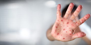 România e în prag de epidemie de rujeolă. Boala, care fusese eradicată prin vaccinare, se răspândește acum exponențial