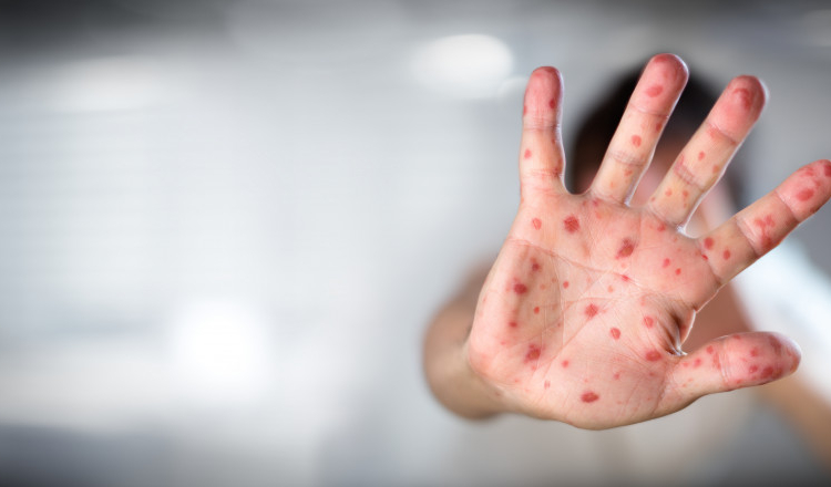 România e în prag de epidemie de rujeolă. Boala, care fusese eradicată prin vaccinare, se răspândește acum exponențial