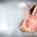 România e în prag de epidemie de rujeolă. Boala, care fusese eradicată prin vaccinare, se răspândește acum exponențial