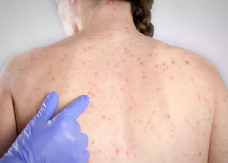 Ce înseamnă declararea epidemiei de rujeolă în România. Care sunt simptomele bolii și ce complicații apar