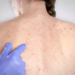 Ce înseamnă declararea epidemiei de rujeolă în România. Care sunt simptomele bolii și ce complicații apar