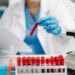 Un test de sânge ar putea depista cu precizie cancerul ovarian în stadii incipiente (studiu)